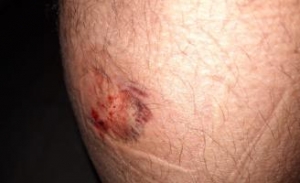 NUEVA AGRESI&Oacute;N A UN FUNCIONARIO EN TENERIFE II